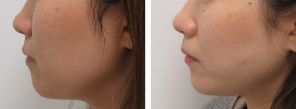 TAC式 ツヤ肌コラーゲンリフト®/顎のヒアルロン酸注射の症例写真 施術前後 １週間