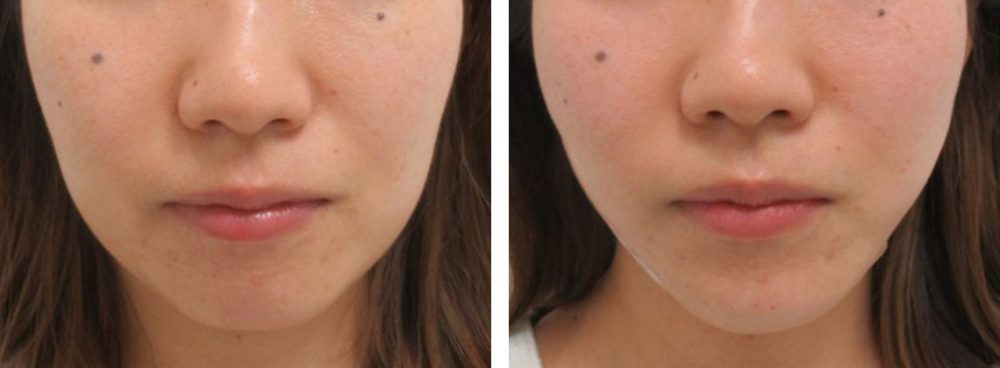 TAC式 ツヤ肌コラーゲンリフト®/顎のヒアルロン酸注射の症例写真 施術前後 直後