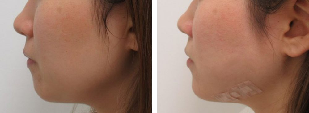 TAC式 ツヤ肌コラーゲンリフト®/顎のヒアルロン酸注射の症例写真 施術前後 直後