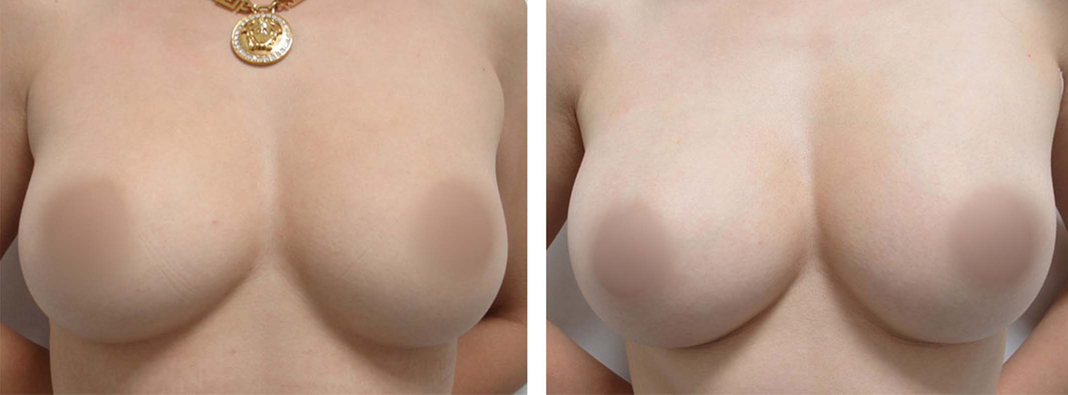 ヒアルロン酸注入豊胸術(グラビアバスト)の症例写真 施術前後 3日