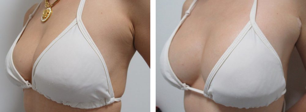 ヒアルロン酸注入豊胸術(グラビアバスト)の症例写真 施術前後 直後