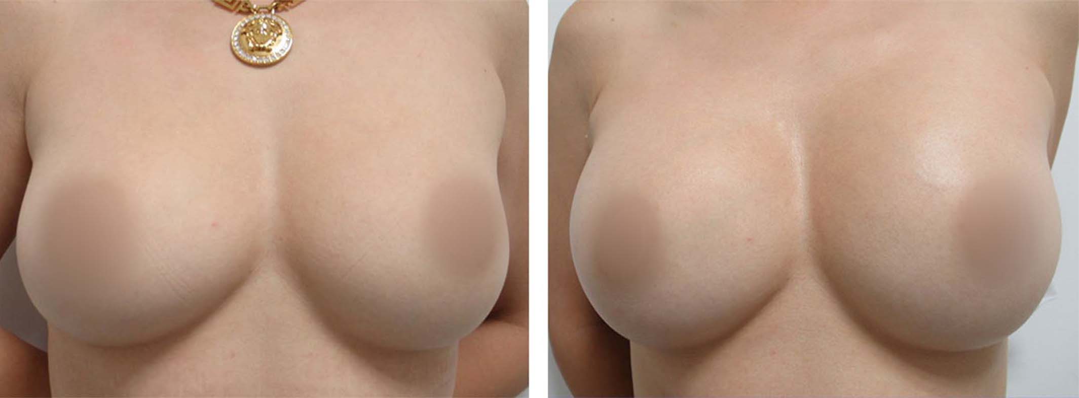 ヒアルロン酸注入豊胸術(グラビアバスト)の症例写真 施術前後 直後