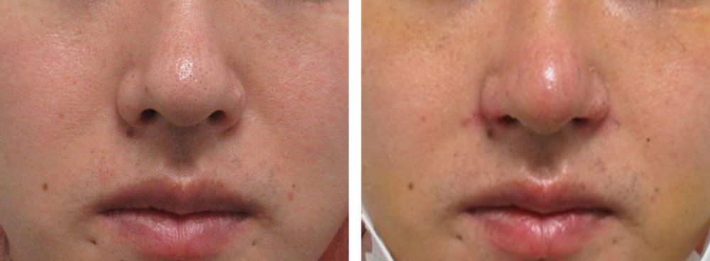 鼻孔縁挙上術/TAC式 鼻翼縮小術(小鼻縮小)の症例写真 施術前後 1週間