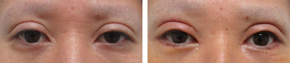 二重切開（全切開法）/グラマラスライン（タレ目形成）/眼瞼下垂（目つき矯正）の症例写真 施術前後 １週間