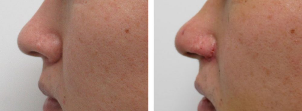 鼻孔縁挙上術/TAC式 鼻翼縮小術(小鼻縮小)の症例写真 施術前後 1週間