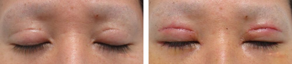 二重切開（全切開法）/グラマラスライン（タレ目形成）/眼瞼下垂（目つき矯正）の症例写真 施術前後 １週間