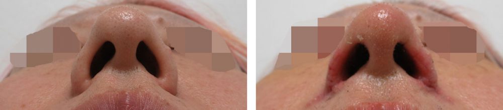 鼻孔縁挙上術/TAC式 鼻翼縮小術(小鼻縮小)の症例写真 施術前後 1週間