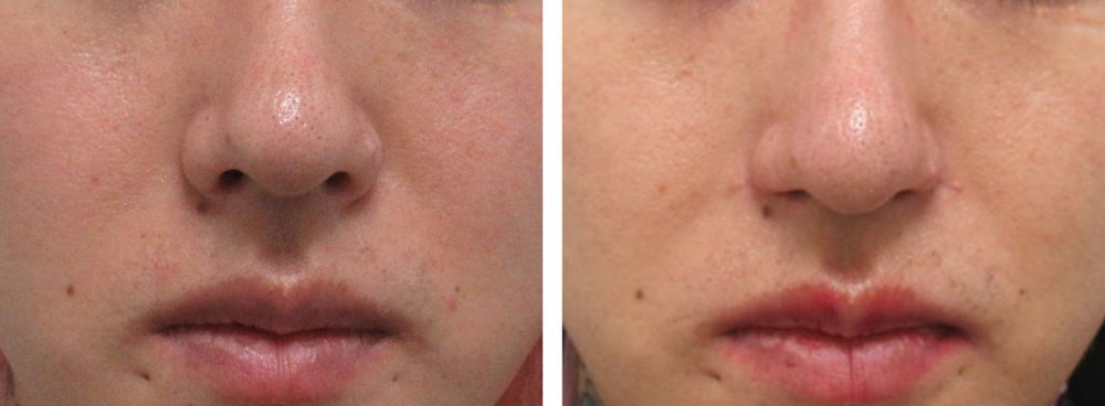鼻孔縁挙上術/TAC式 鼻翼縮小術(小鼻縮小)の症例写真 施術前後 2ヵ月