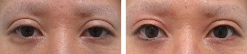 二重切開（全切開法）/グラマラスライン（タレ目形成）/眼瞼下垂（目つき矯正）の症例写真 施術前後 ２ヵ月