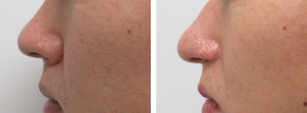 鼻孔縁挙上術/TAC式 鼻翼縮小術(小鼻縮小)の症例写真 施術前後 2ヵ月