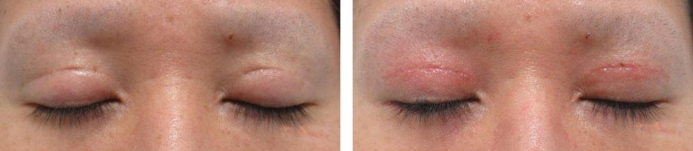 二重切開（全切開法）/グラマラスライン（タレ目形成）/眼瞼下垂（目つき矯正）の症例写真 施術前後 ２ヵ月