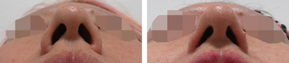 鼻孔縁挙上術/TAC式 鼻翼縮小術(小鼻縮小)の症例写真 施術前後 2ヵ月