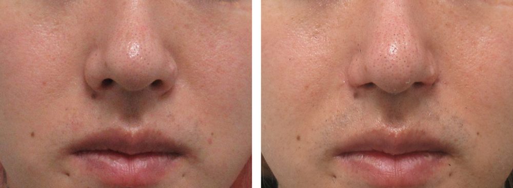 鼻孔縁挙上術/TAC式 鼻翼縮小術(小鼻縮小)の症例写真 施術前後 3ヵ月