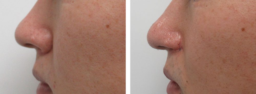 鼻孔縁挙上術/TAC式 鼻翼縮小術(小鼻縮小)の症例写真 施術前後 3ヵ月