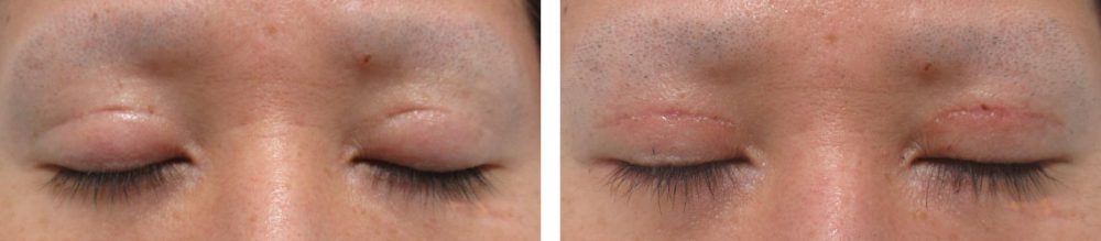 二重切開（全切開法）/グラマラスライン（タレ目形成）/眼瞼下垂（目つき矯正）の症例写真 施術前後 ３ヵ月