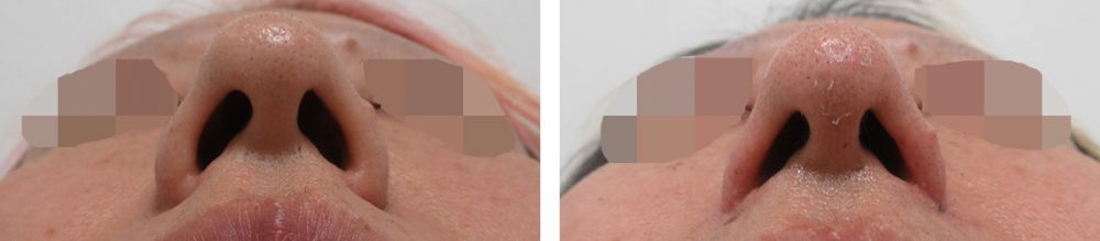 鼻孔縁挙上術/TAC式 鼻翼縮小術(小鼻縮小)の症例写真 施術前後 3ヵ月