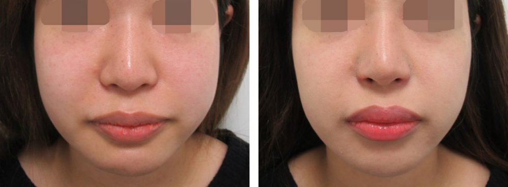 鼻尖4Dノーズ/鼻翼挙上術/鼻孔縁挙上術の症例写真 施術前後 １ヵ月（化粧無し）