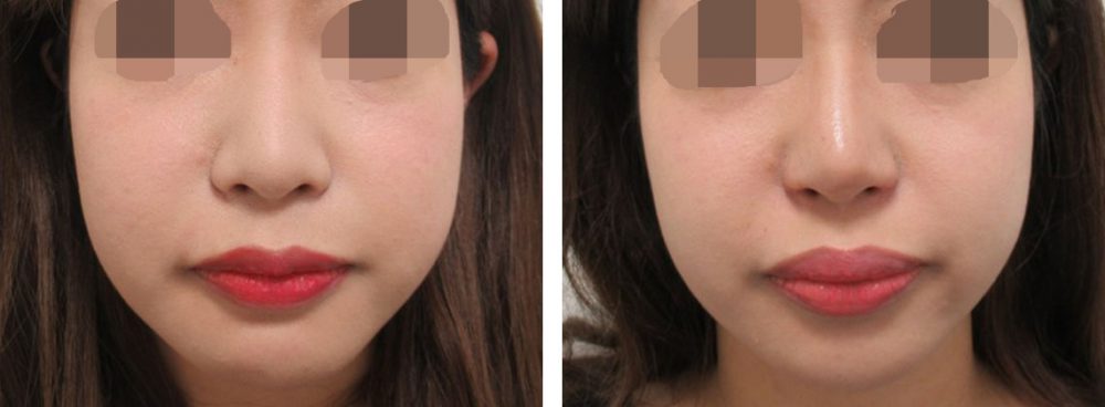 鼻尖4Dノーズ/鼻翼挙上術/鼻孔縁挙上術の症例写真 施術前後 １ヵ月（化粧有り）