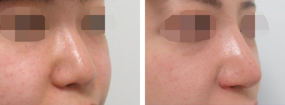 鼻尖4Dノーズ/鼻翼挙上術/鼻孔縁挙上術の症例写真 施術前後 １ヵ月（化粧無し）