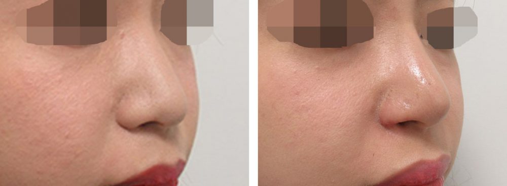 鼻尖4Dノーズ/鼻翼挙上術/鼻孔縁挙上術の症例写真 施術前後 １ヵ月（化粧有り）
