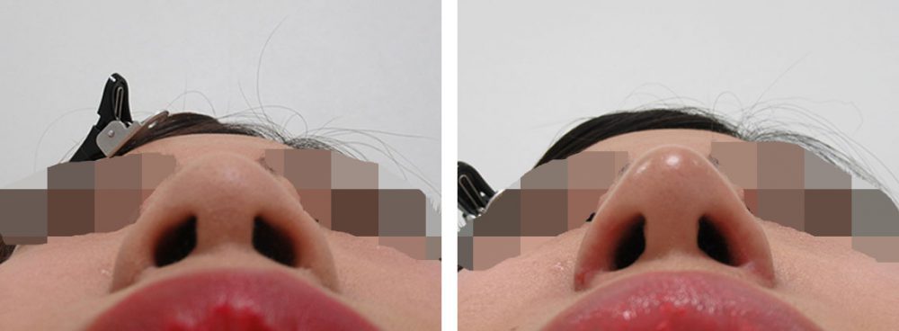 お鼻の複合施術で一段と綺麗な顔立ちへ