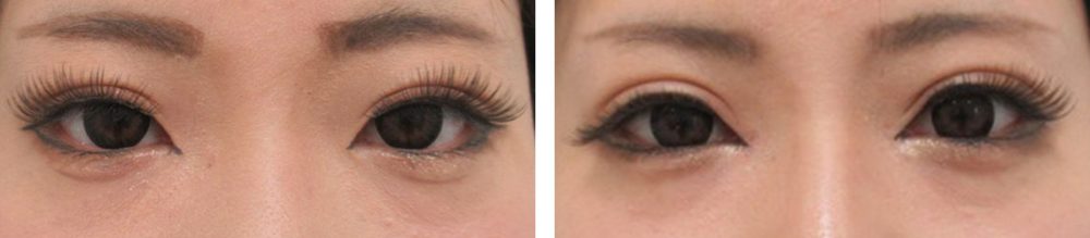 二重切開（全切開法）/目頭切開術/目尻切開術の症例写真 施術前後 １ヵ月化粧あり