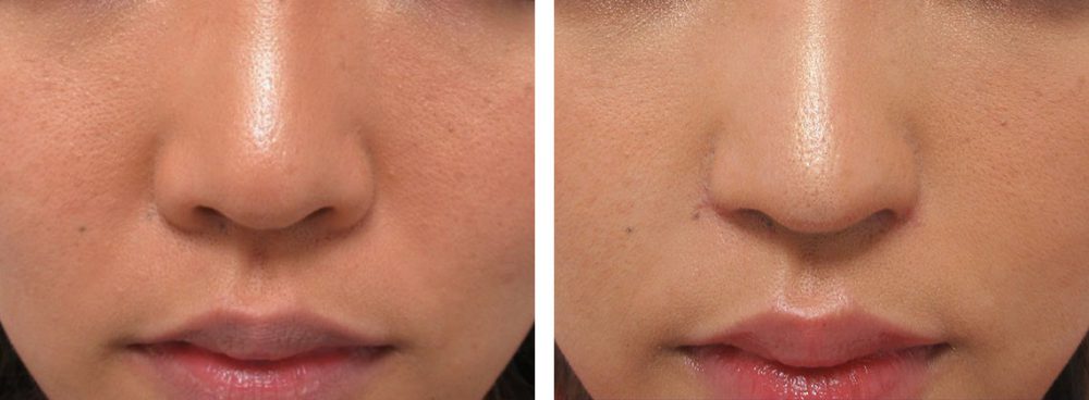 TAC式 鼻翼縮小術（小鼻縮小）/鼻翼挙上術/鼻孔縁挙上術の症例写真 施術前後 １.５ヵ月