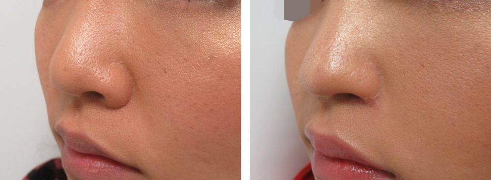 鼻孔縁拳上術を含むお鼻の改善