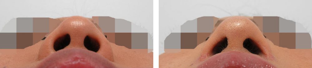 TAC式 鼻翼縮小術（小鼻縮小）/鼻翼挙上術/鼻孔縁挙上術の症例写真 施術前後 １.５ヵ月