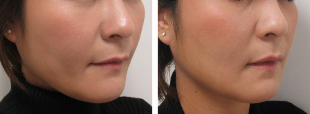 TAC式 ツヤ肌コラーゲンリフト®/ボトックス注射：その他の症例写真 施術前後 １週間