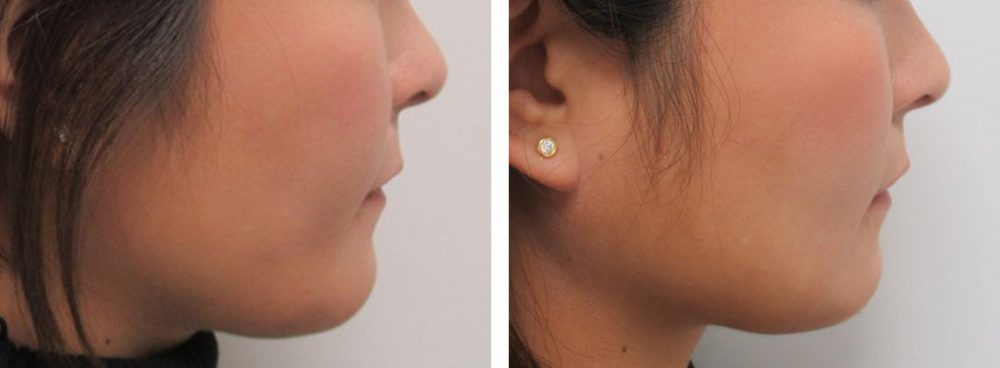 TAC式 ツヤ肌コラーゲンリフト®/ボトックス注射：その他の症例写真 施術前後 １週間