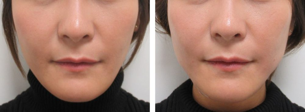 TAC式 ツヤ肌コラーゲンリフト®/ボトックス注射：その他の症例写真 施術前後 直後