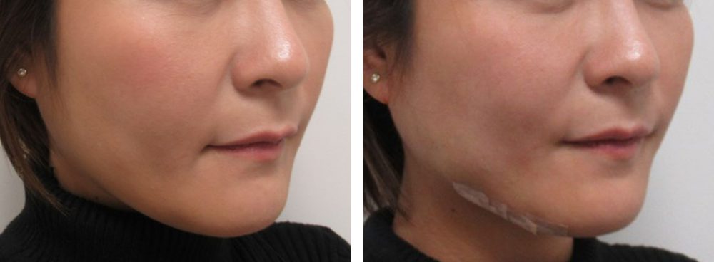 TAC式 ツヤ肌コラーゲンリフト®/ボトックス注射：その他の症例写真 施術前後 直後