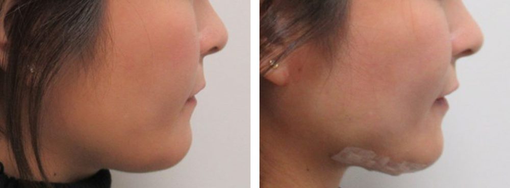 TAC式 ツヤ肌コラーゲンリフト®/ボトックス注射：その他の症例写真 施術前後 直後