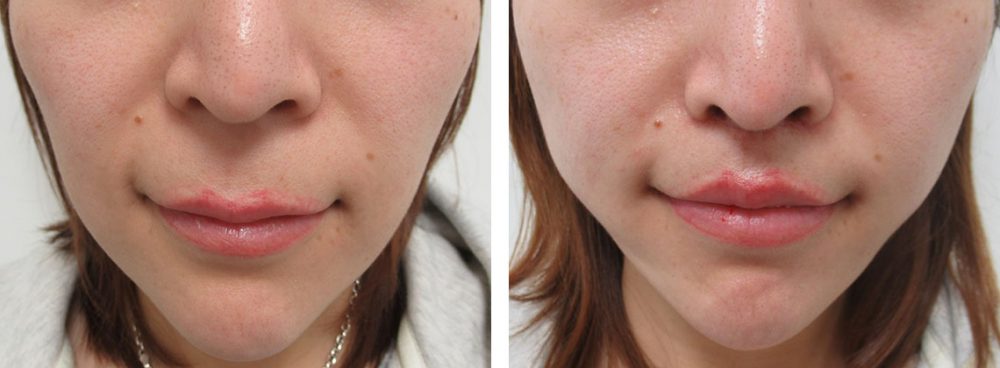 人中短縮術(リップリフト)・外側人中短縮術/TAC式 ツヤ肌コラーゲンリフト®/口角挙上・リフト（マイクロ切開法・内側法/口内法）の症例写真 施術前後 １.５ヵ月