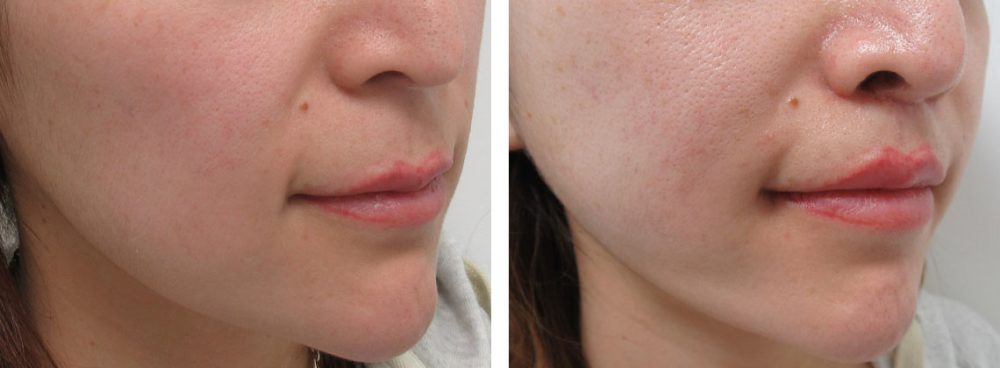 口角リフトと人中短縮の組み合わせ