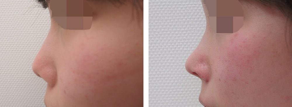 ヴィーナスノーズ（切らない鼻中隔延長術）/鼻尖4Dノーズ/鼻尖形成・鼻尖縮小の症例写真 施術前後 １０日