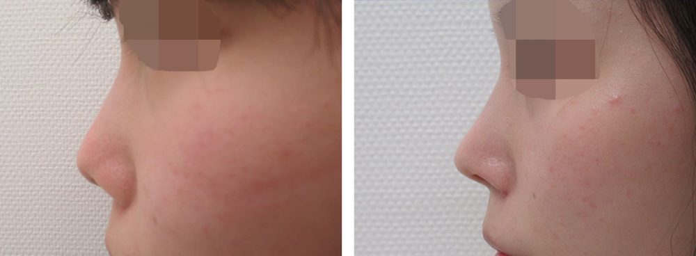 お鼻のラインが整うと横から見ても美人の印象に