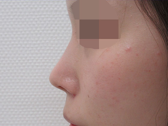 お鼻のラインが整うと横から見ても美人の印象に 症例写真 Taクリニック 美容整形 美容外科 新宿 銀座 大阪 福岡 高崎