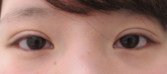 症例写真 ダウンタイム グラマラスライン切開と目尻靭帯移動術でタレ目を作る Taクリニック 美容整形 美容外科 新宿 銀座 横浜 大阪 福岡 川越 高崎 Taクリニック 美容整形 美容外科