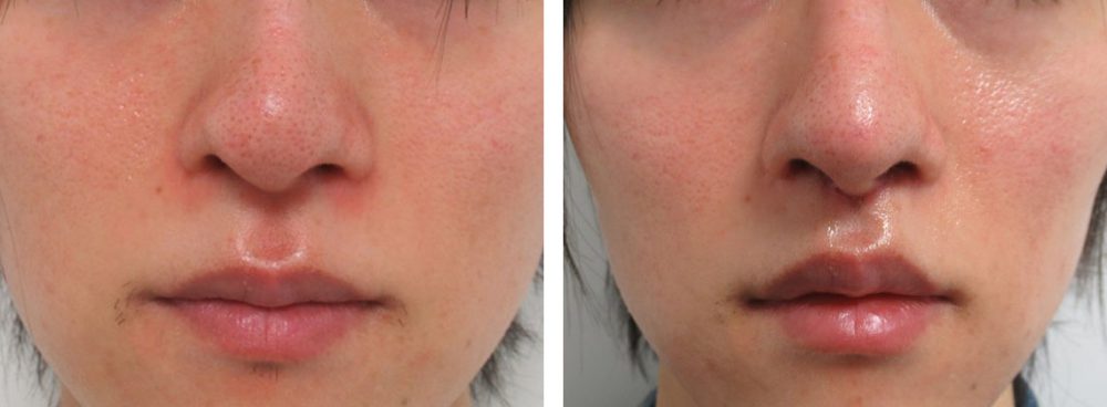 人中短縮術(リップリフト)・外側人中短縮術/鼻尖4Dノーズ/鼻尖形成・鼻尖縮小の症例写真 施術前後 1ヵ月