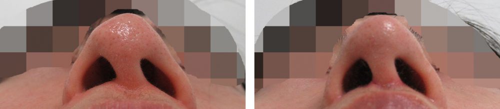人中短縮術(リップリフト)・外側人中短縮術/鼻尖4Dノーズ/鼻尖形成・鼻尖縮小の症例写真 施術前後 1ヵ月