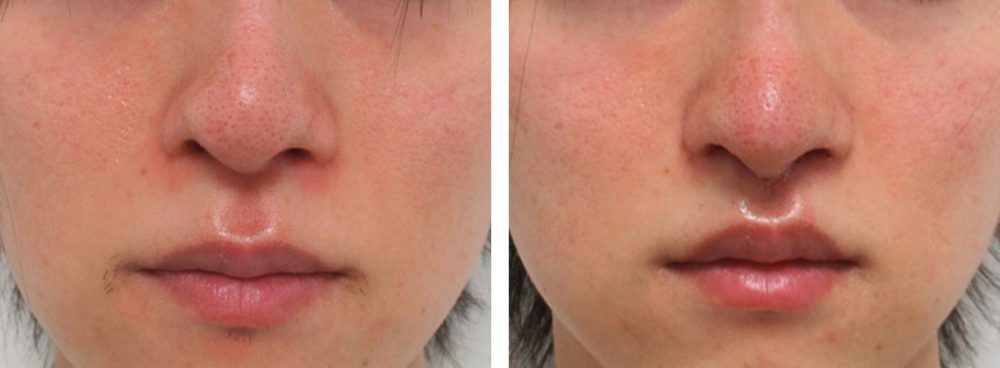 人中短縮術(リップリフト)・外側人中短縮術/鼻尖4Dノーズ/鼻尖形成・鼻尖縮小の症例写真 施術前後 1週間