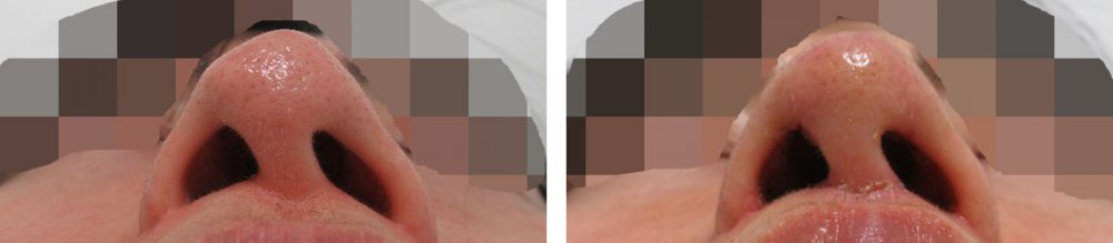 人中短縮術(リップリフト)・外側人中短縮術/鼻尖4Dノーズ/鼻尖形成・鼻尖縮小の症例写真 施術前後 1週間