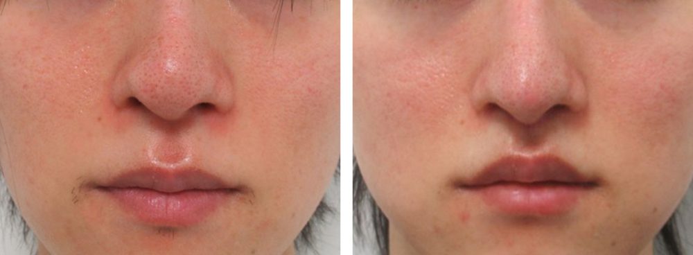 変形したお鼻を整える