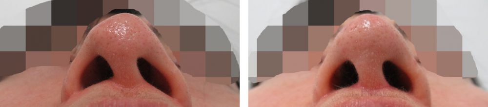 人中短縮術(リップリフト)・外側人中短縮術/鼻尖4Dノーズ/鼻尖形成・鼻尖縮小の症例写真 施術前後 3ヵ月