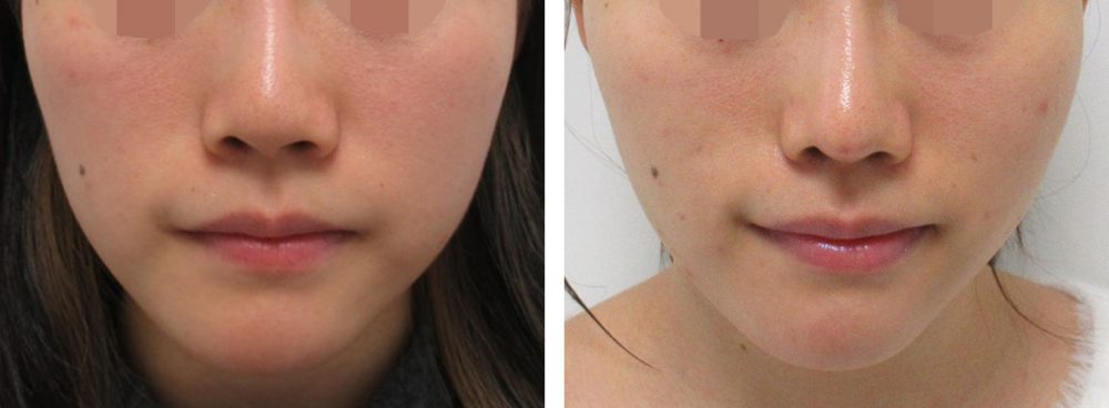 横に広がった小鼻を小さくし鼻先に高さをだす