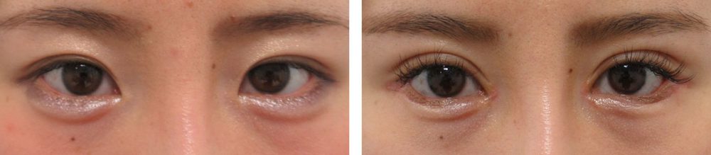 二重切開（全切開法）/目頭切開術/グラマラスライン（タレ目形成）の症例写真 施術前後 １ヵ月（化粧有り）