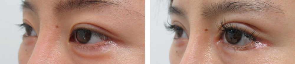 二重切開（全切開法）/目頭切開術/グラマラスライン（タレ目形成）の症例写真 施術前後 １ヵ月（化粧無し）