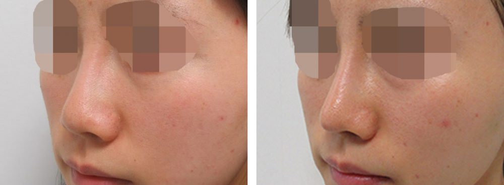 ヴィーナスノーズ（切らない鼻中隔延長術）/鼻尖4Dノーズ/隆鼻術（プロテーゼ・自家組織）の症例写真 施術前後 １ヵ月